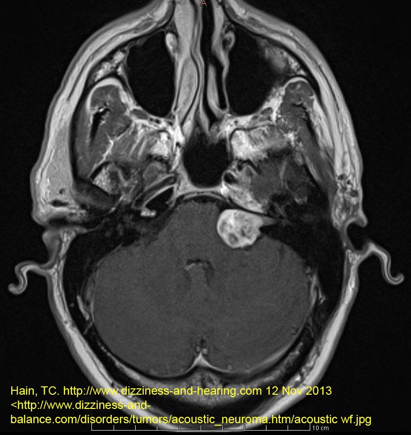 acoustic neuroma